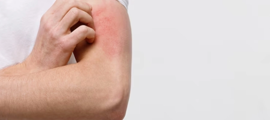 Manchas Vermelhas na Pele: 18 Possíveis Causas e Tratamento